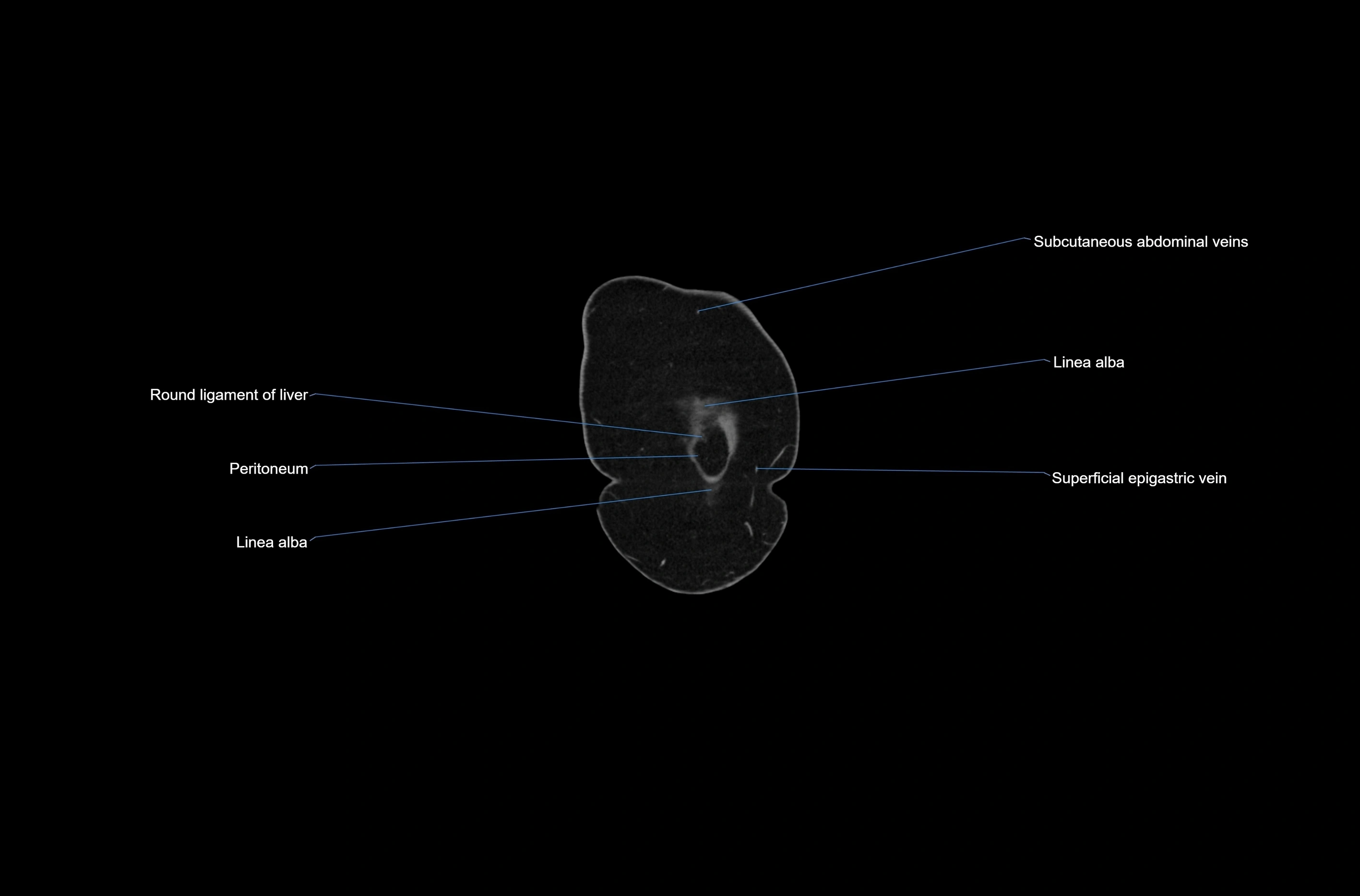 CT abdomen coronal cross sectional anatomy labelled radiology image-00003.webp